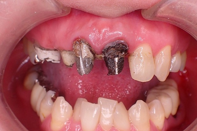 前歯除去後　虫歯