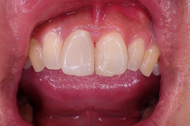 再石灰化　初期の虫歯は削らず治す