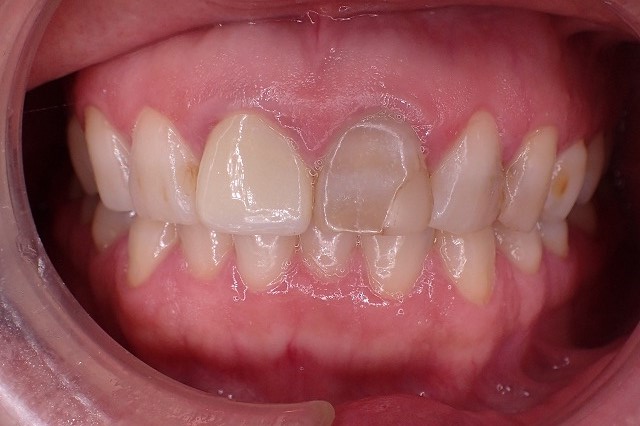 テトラサイクリンによる歯の着色
