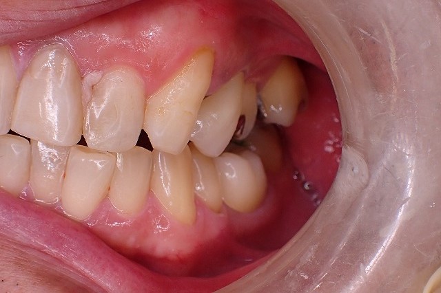 ウルトラトランスジルコニア　小臼歯