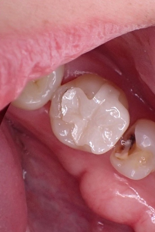 ジルコニアインレー虫歯