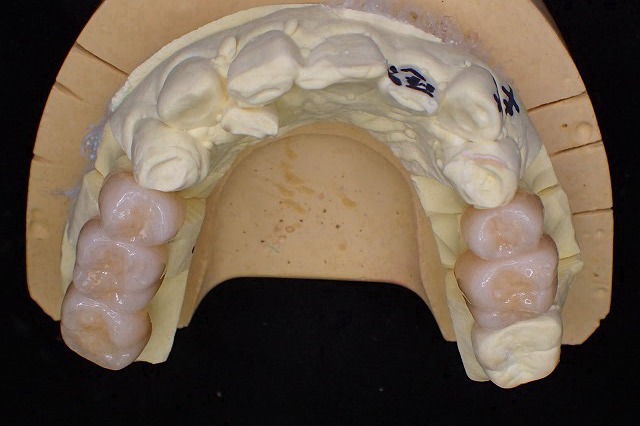 ジルコニア　臼歯