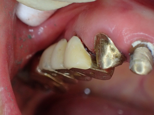 初診時前歯の状態