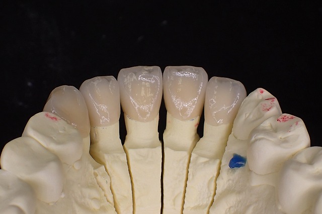 emax前歯　作業模型　裏側　透明ガラスエナメル質