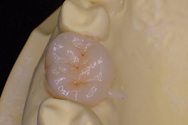 ウルトラハイトランスジルコニア　大臼歯