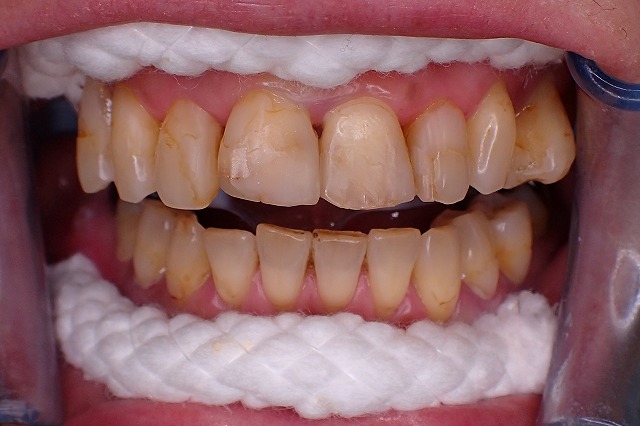 虫歯修復後　劣化しています　前歯いじりすぎ