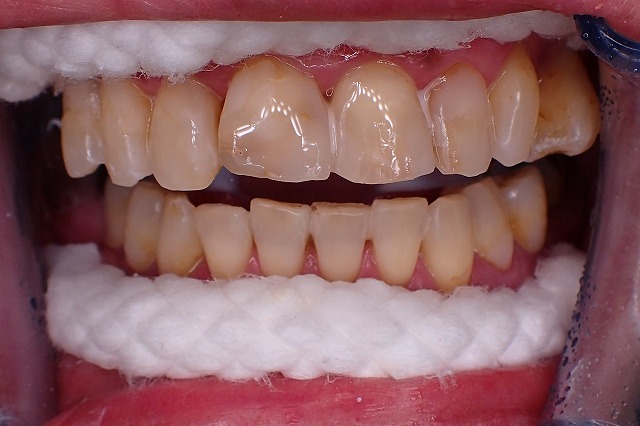 虫歯修復　劣化　ホワイトニング後
