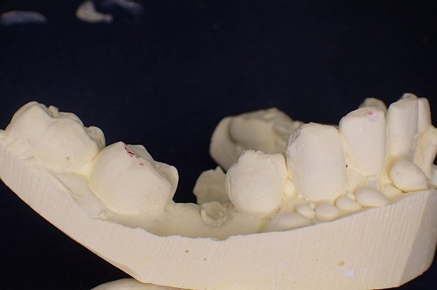 顎の変形　虫歯の放置