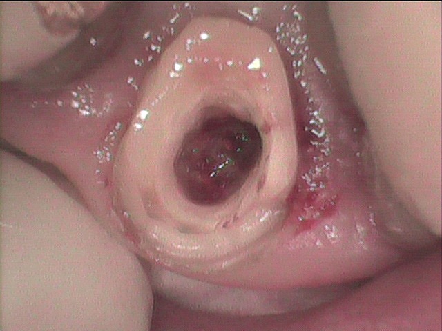 根管内部虫歯