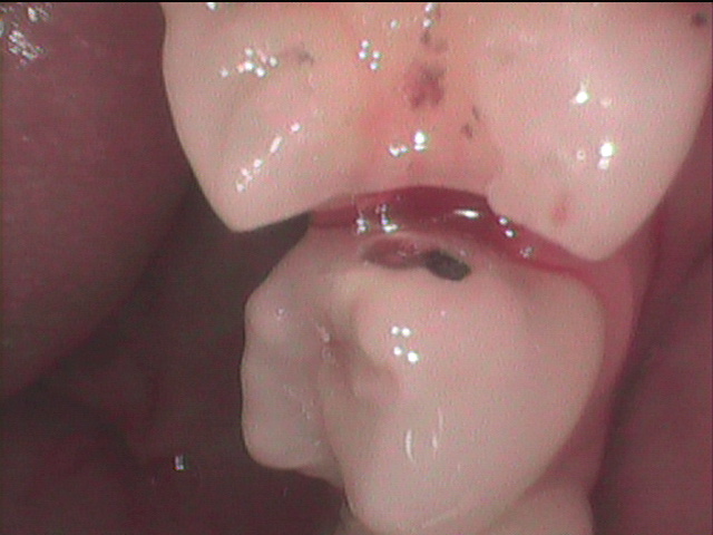 除去した隣の歯が虫歯