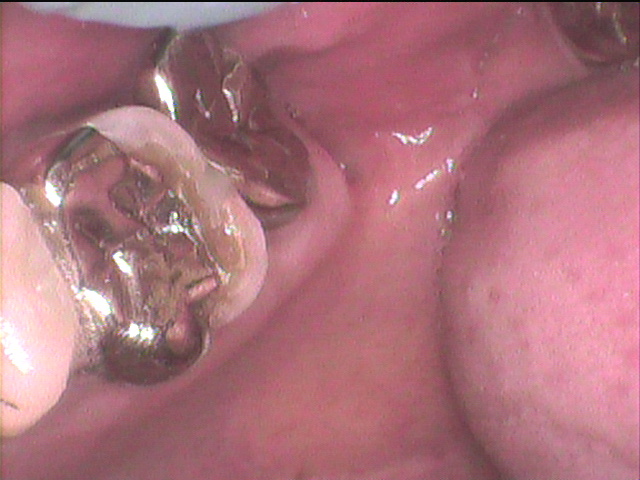 インレーの中虫歯