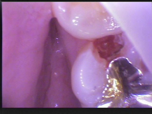 隣接面の虫歯