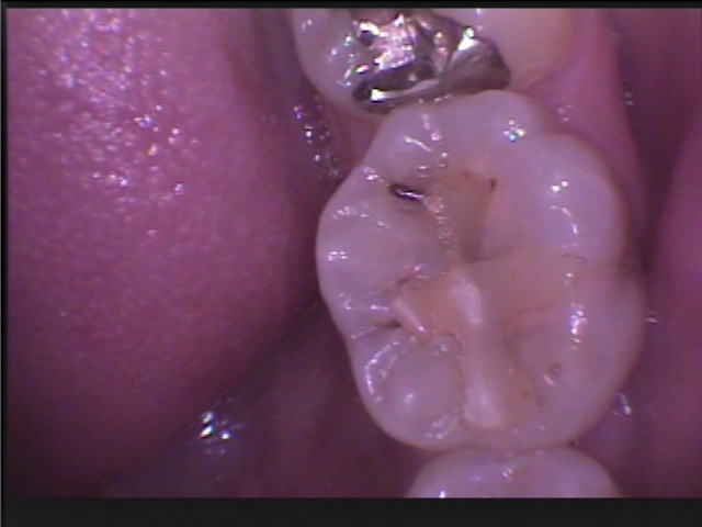 奥歯のレジン充填は虫歯になりやすい