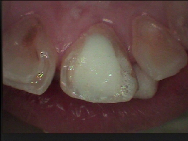 失活歯のホワイトニング