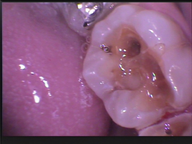 さらに除去すると広範囲な虫歯