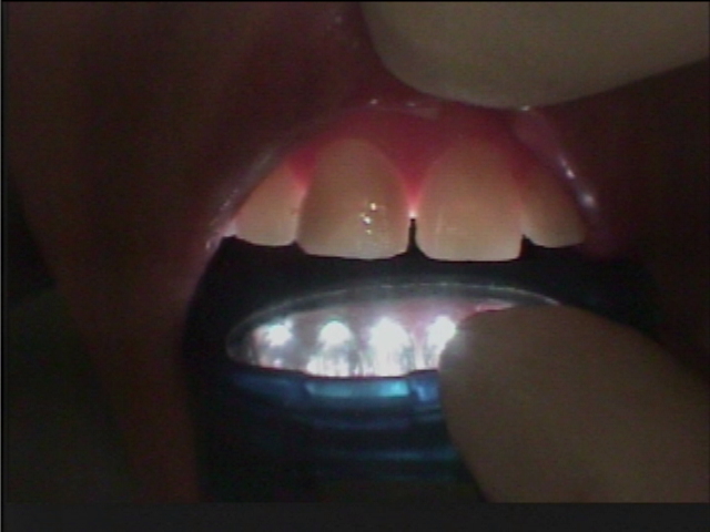 虫歯の歯を光透過