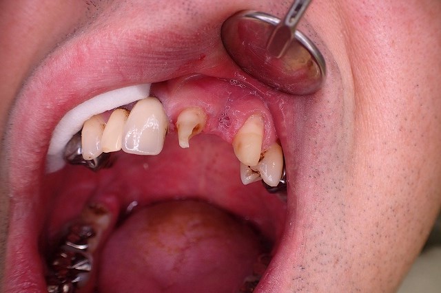 仮歯の中で歯が崩壊