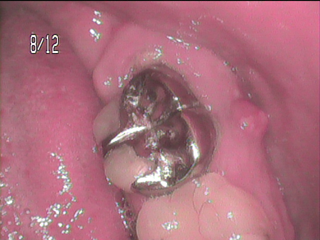 歯髄壊疽　根尖病巣
