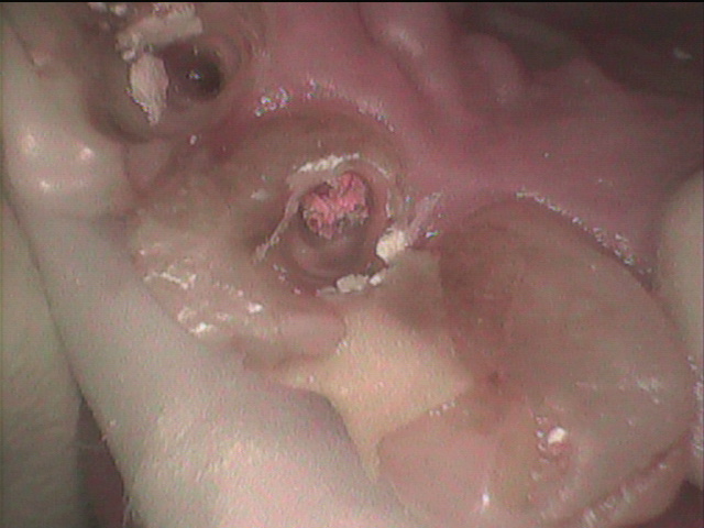 前歯　感染根管治療