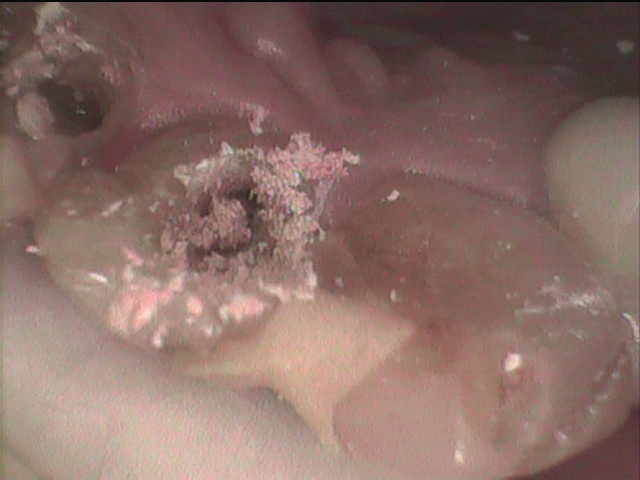 前歯　感染根管治療　根管充填剤の除去