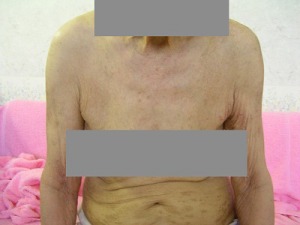 汎発性湿疹治療7か月後2