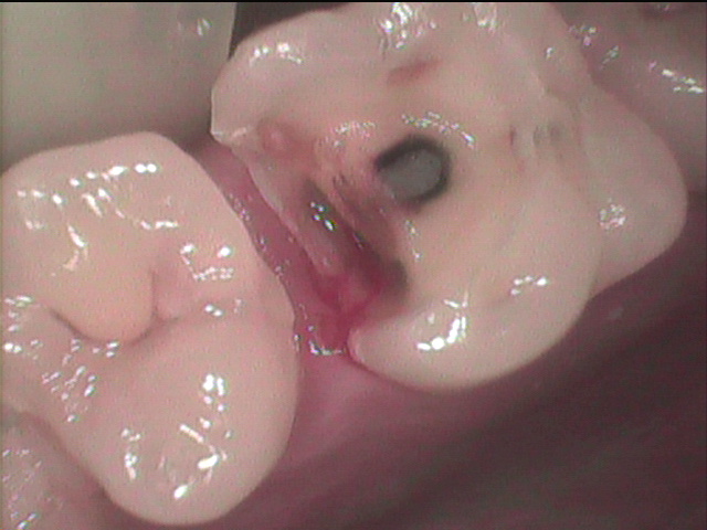 次にカリエス虫歯