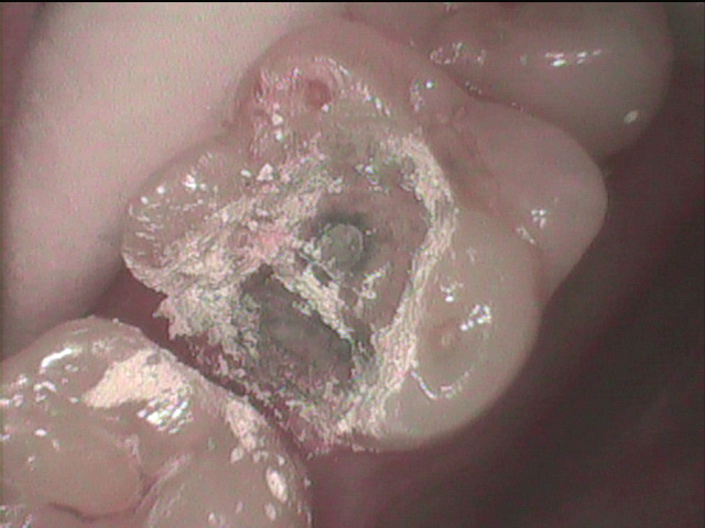 レーザー処理後の歯面