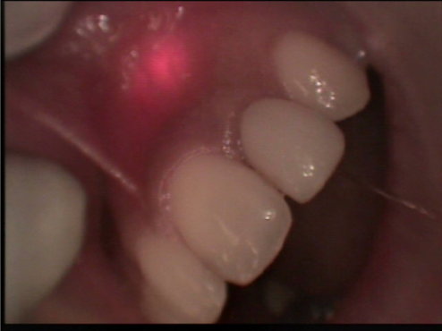 前歯　根尖病巣