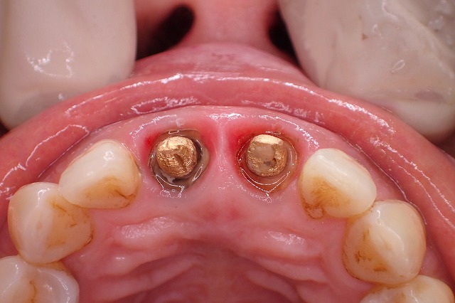 前歯位置関係　口蓋観