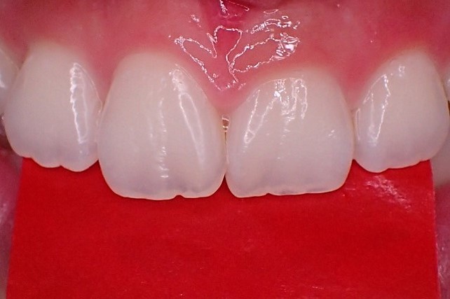 ホワイトニング　歯の透明感　天然歯のエナメル
