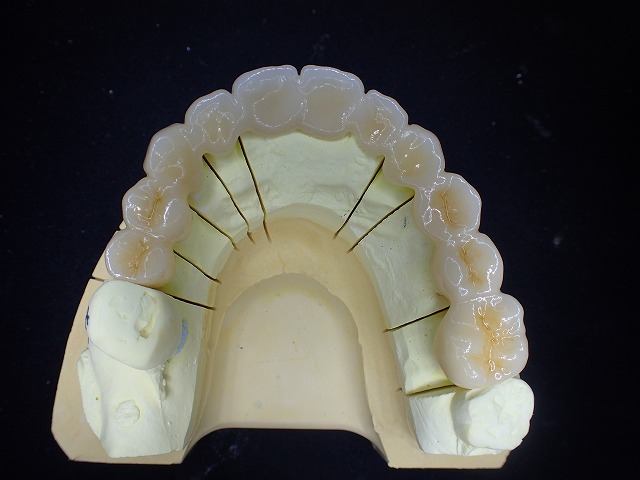 マルチレイヤージルコニア