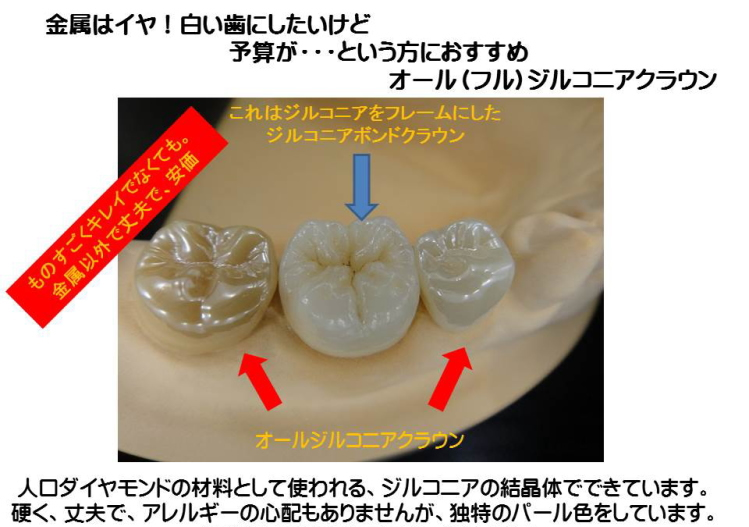 歯科 歯科技工 上顎右側フルジルコニアCr サンプル-