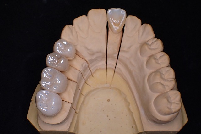 ジルコニア進化の歴史 横浜市鶴見区 鶴見駅の歯科 歯医者 北村歯科