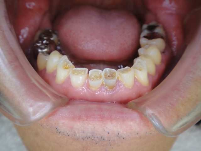 歯ぎしり する 人 の 歯