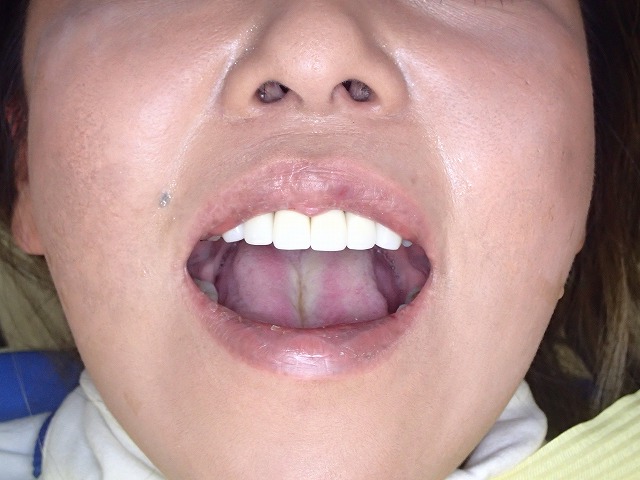 ジルコニア装着後調整3回目