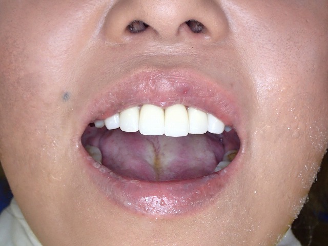 ジルコニア装着直後