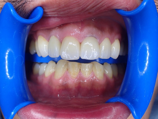 ホワイトニング1回目照射前