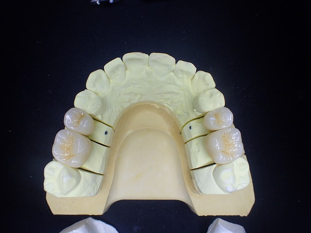 咬合の中心点と思われる部位