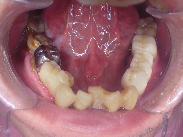 ジルコニア装着