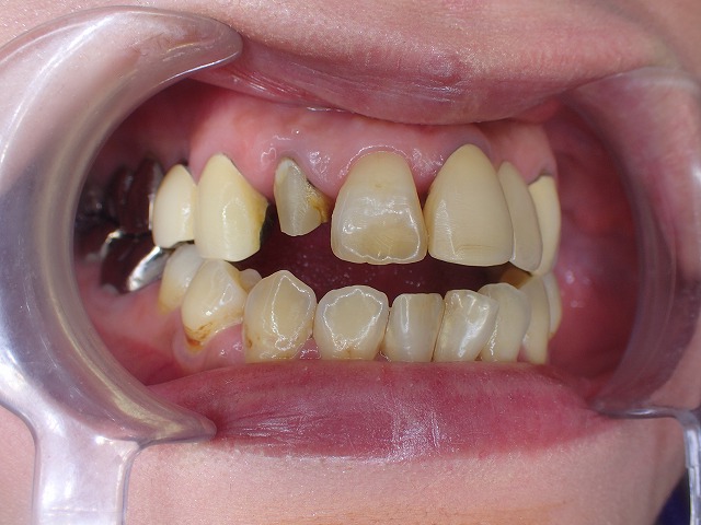 根管治療後ファイバーコアを製作