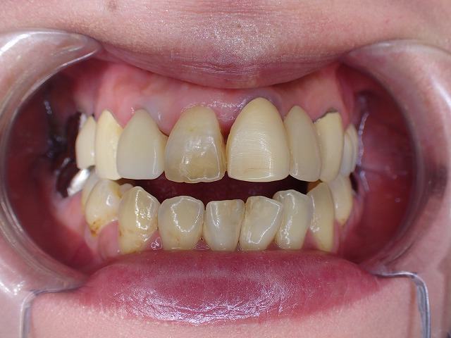 自由診療は状態のよくない歯には おすすめしていません。