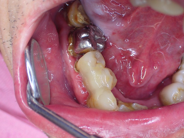 最後の手段　ファイバ－を入れてグラグラの歯を維持する