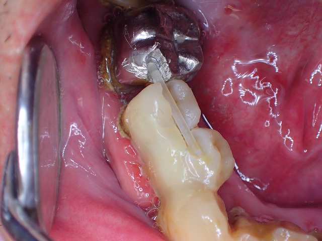 ファイバ－を入れてグラグラの歯を維持する　ファイバ