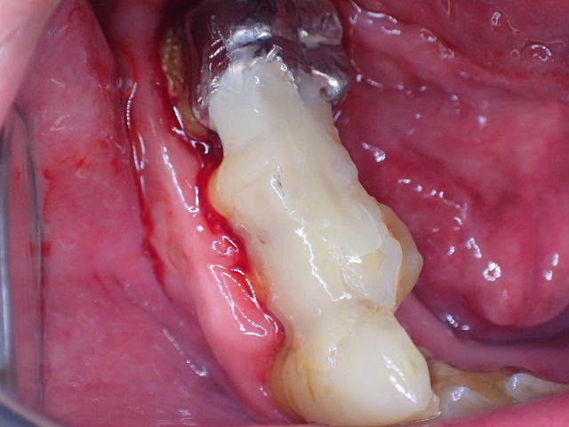 ファイバ－を入れてグラグラの歯を維持する