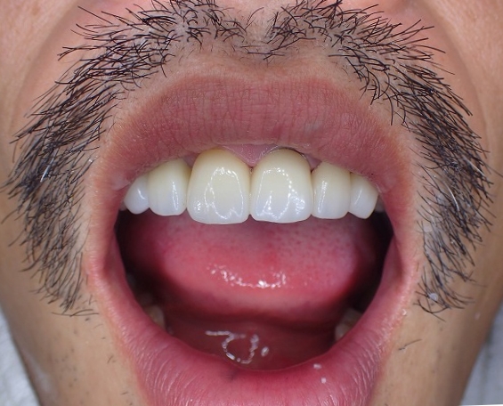 形態修正 第一段階