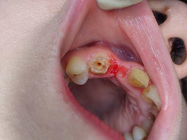 仮 歯 の まま 転院