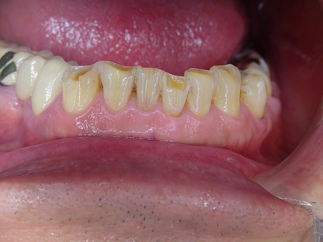 列 いい やめた 歯 矯正 ほうが 40代の歯列矯正は失敗する？経験者がリアルに告白【矯正ブログ】