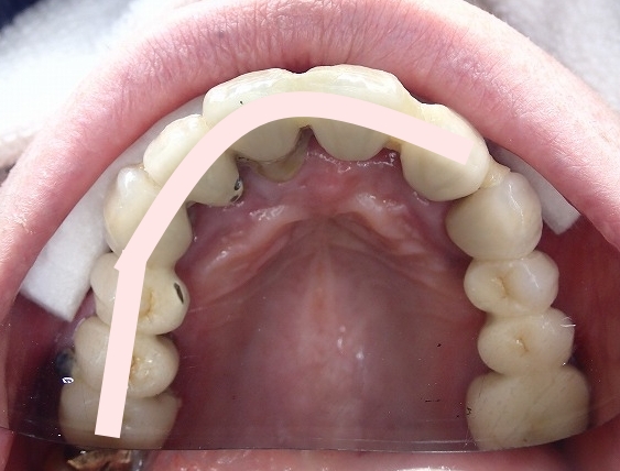 限界的な歯周病と虫歯を併発している状態