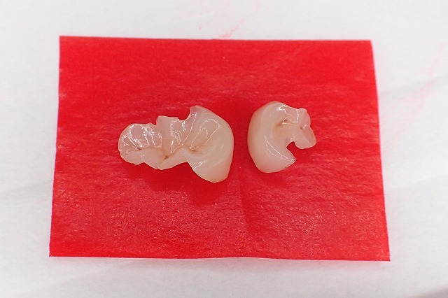e.maxインレー　透明感がわかる画像